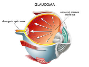Chart Showing Pressure Building in an Eye Due to Glaucoma